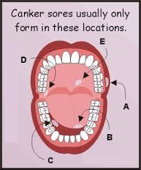 canker sores diagram