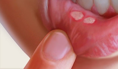 canker sores