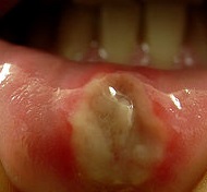 major canker sore