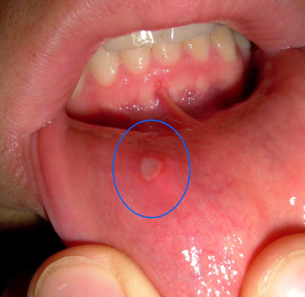 minor canker sore